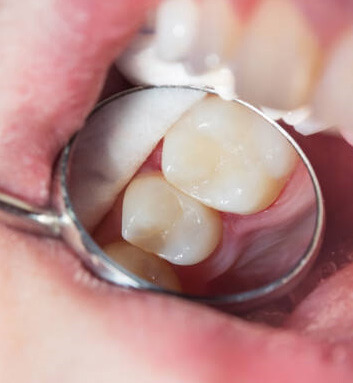 White filling visible in dental mirror 