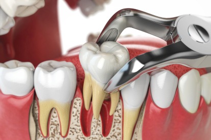 Illustration of tooth being removed