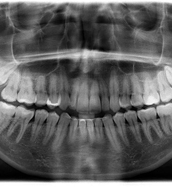 X-rays with wisdom teeth coming in